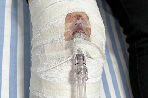 Trauma Relief Plaster Application
