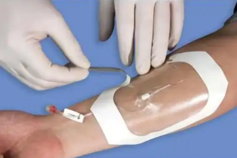 High-Absorbency Bordered Catheter Fixing Dressing